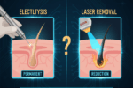 Electrolysis vs. Laser Hair Removal